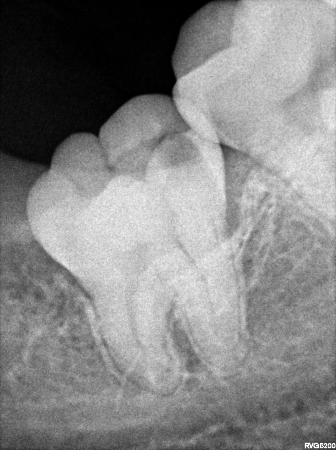 Dental X-ray